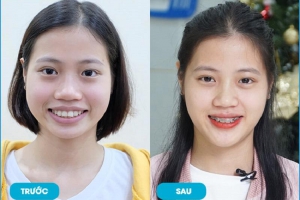 Lột Xác Ngoạn Mục Sau Khi Niềng Răng: Hành Trình Và Kết Quả