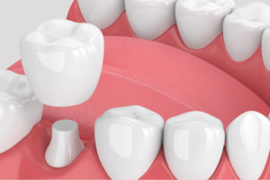 Còn Chân Răng Có Bọc Sứ Được Không? Tư Vấn Từ Bác Sĩ