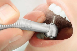 Dán Sứ Veneer Không Mài Răng: Công Nghệ Mới Cho Nụ Cười Đẹp