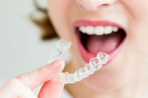 Bảng giá chi tiết 2024 Niềng răng trong suốt