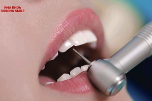 Hình Ảnh Răng Sau Khi Mài: Trải Nghiệm Thực Tế