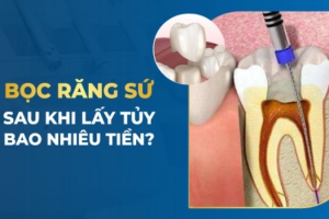 Lấy Tủy Bọc Răng Sứ Giá Bao Nhiêu? Cập Nhật Chi Tiết 2024
