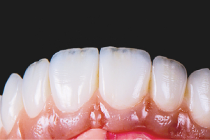 Mão Răng Sứ: Công Dụng Và Quy Trình Thực Hiện