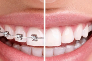 Nên Niềng Răng Hay Bọc Sứ: Lựa Chọn Tối Ưu Cho Nụ Cười