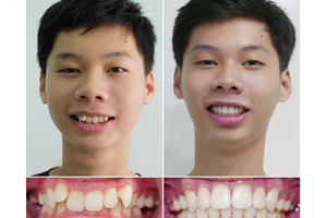 CÔNG NGHỆ NIỀNG RĂNG MỚI NHẤT HIỆU QUẢ VÀ TIẾT KIỆM THỜI GIAN