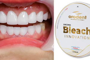 Răng sứ Orodent Bleach Innovation: Nâng tầm đẳng cấp nụ cười Việt