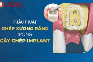 Phẫu Thuật Ghép Xương Răng Trong Cấy Ghép Implant