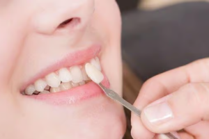 Răng Cửa Nên Bọc Sứ Loại Nào? Tư Vấn Lựa Chọn