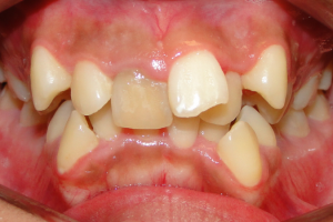 Răng Mọc Lệch Có Bọc Sứ Được Không? Lời Khuyên Từ Chuyên Gia