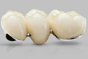 Răng Sứ Ceramco: Lựa Chọn Hoàn Hảo Cho Nụ Cười Tươi Sáng