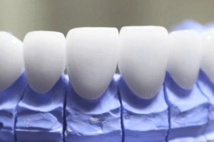 Răng Sứ Ceramill: Sự Lựa Chọn Hoàn Hảo Cho Nụ Cười