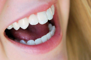 Răng Sứ Cercon Của Nước Nào? Chất Lượng Ra Sao?