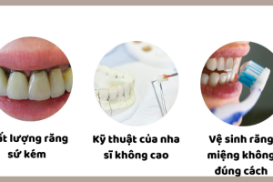 Răng Sứ Có Bị Ố Vàng Không? Bảo Quản Như Thế Nào?