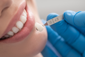 Răng Sứ Có Trắng Lên Được Không? Bí Quyết Bảo Quản