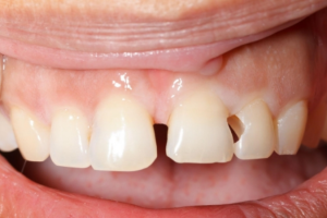 Răng Sứ Hỏng: Nguyên Nhân Và Cách Khắc Phục