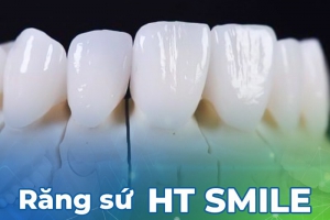 Răng Sứ HT Smile:  Lựa chọn hàng đầu cho răng thẩm mỹ