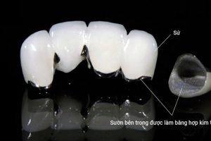 Răng Sứ Titan Sử Dụng Được Bao Lâu? Thông Tin Chi Tiết