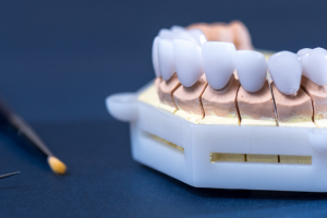 Răng Sứ Vita: Sự Lựa Chọn Hoàn Hảo Cho Răng Thẩm Mỹ