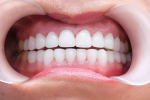 Răng Sứ Zirconia Hàn Quốc: Đột Phá Trong Công Nghệ Làm Răng