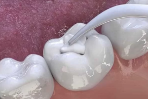 Răng Sứt Mẻ Có Trám Được Không? Giải Pháp Phục Hồi