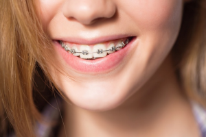 Răng Thưa Nên Niềng Hay Bọc Sứ? Lời Khuyên Từ Bác Sĩ