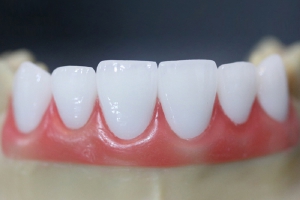 Răng Sứ Emax Express: Nụ cười tỏa sáng, thay đổi cuộc sống