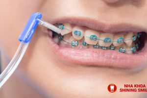 Đang Niềng Răng Mà Bị Sâu Răng: Cách Xử Lý và Phòng Ngừa