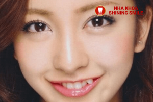 Niềng Răng Khểnh: Cần Nhổ Răng Không và Những Lưu Ý Quan Trọng