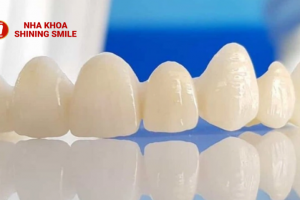 Răng Thưa Nên Niềng Hay Bọc Sứ? Giải Pháp Tối Ưu Cho Nụ Cười Hoàn Hảo