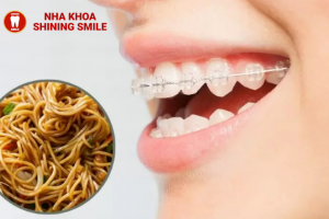 Niềng Răng Ăn Mì Được Không? Lời Khuyên Từ Nha Sĩ