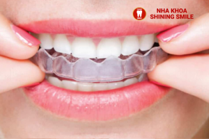 Niềng Răng Có Ảnh Hưởng Đến Gò Má Không? Giải Đáp Từ Chuyên Gia