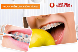 Nhược Điểm Của Niềng Răng: Những Điều Cần Biết Trước Khi Quyết Định