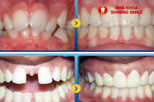 Lớn Tuổi Có Niềng Răng Được Không? Các Yếu Tố Cần Xem Xét