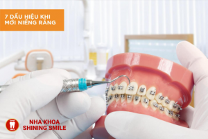 Những Dấu Hiệu Khi Mới Niềng Răng Bạn Cần Biết