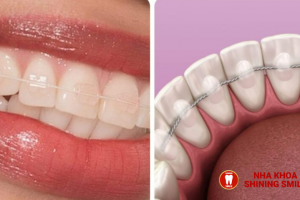 Thời Gian Điều Trị Lệch Khớp Cắn Bằng Niềng Răng: Những Điều Cần Biết