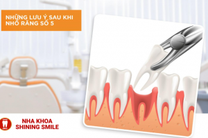 Niềng Răng Nhổ Răng Số 5: Giải Pháp Hoàn Thiện Nụ Cười