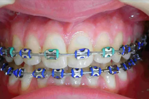 Ưu điểm và hạn chế của niềng răng mắc cài kim loại buộc chun