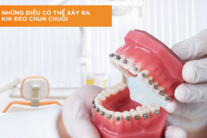 Chun chuỗi niềng răng là gì?  Công dụng và những điều cần biết