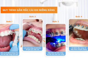 Quy trình gắn mắc cài chuẩn khoa học nhất hiện nay