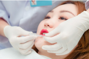 Niềng răng lệch khớp cắn và những điều quan trọng cần biết