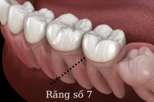 Niềng Răng Có Thể Áp Dụng Cho Người Mất Răng Số 7 Hàm Dưới Không?