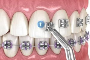 Niềng Răng Mắc Cài Kim Loại Có Đau Không? Giải Đáp Từ Chuyên Gia