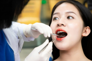 Niềng Răng ở Tuổi 17: Thời Gian Và Kết Quả Mong Đợi