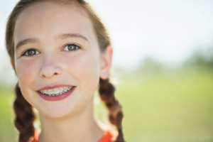 Niềng Răng Cho Trẻ 12 Tuổi: Lợi Ích Và Điều Cần Lưu Ý
