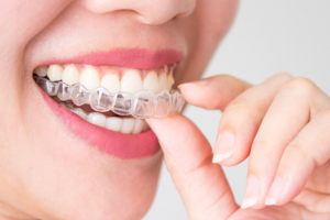 Niềng 4 Răng Cửa: Quy Trình và Kết Quả Mong Đợi