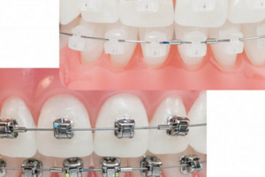 Phân Biệt Mắc Cài Pha Lê và Mắc Cài Sứ: Đâu Là Sự Lựa Chọn Tốt Hơn?