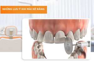 Mài Kẽ Răng Để Niềng Có Hại Không? Lời Khuyên Từ Chuyên Gia