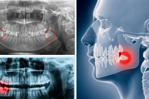 Quyết Định Thời Điểm Nhổ Răng Khôn: Trước Hay Sau Khi Niềng?