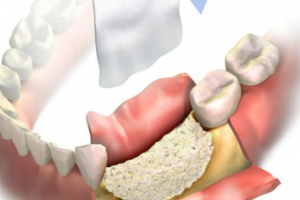 Tiêu Xương Hàm: Liệu Có Thể Niềng Răng Không?