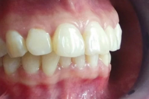 Chỉnh Hàm Hô Nhẹ: Giá Cả và Những Lựa Chọn Phù Hợp